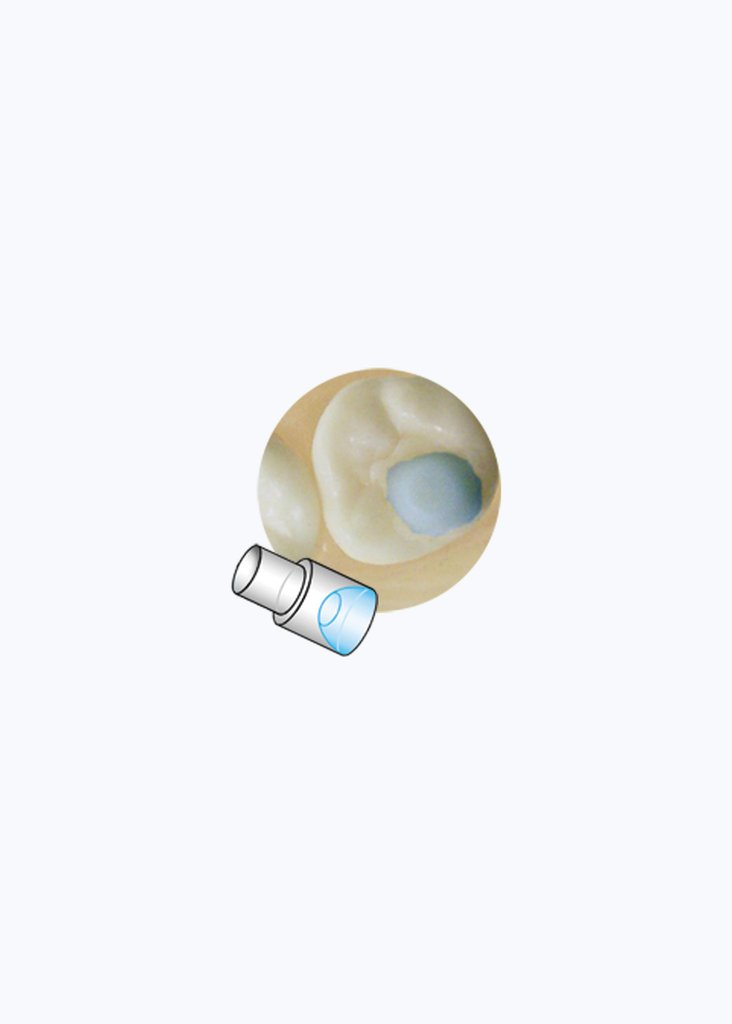 Posterior Molar Pad Mini-Mould Tips