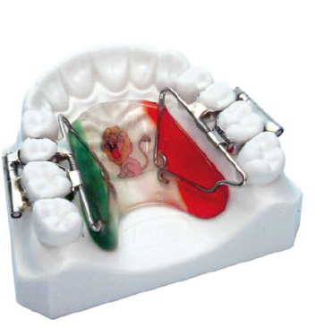 RAPID MOLAR DISTALIZER